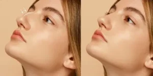 هزینه عمل بینی در شمال