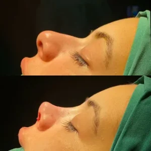 هزینه عمل بینی در شمال هزینه عمل بینی در شمال