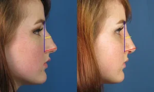 رفع مشکلات تنفسی همراه با جراحی بینی در آمل رفع مشکلات تنفسی همراه با جراحی بینی در آمل