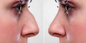 جراحی زیبایی بینی دخترونه در آمل