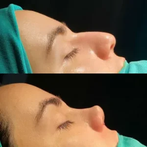 هزینه عمل بینی در شمال هزینه عمل بینی در شمال