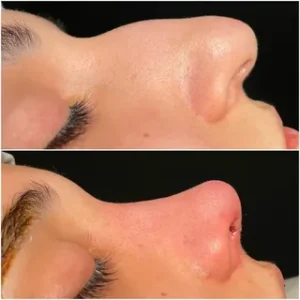 هزینه عمل بینی در شمال هزینه عمل بینی در شمال