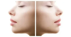 جراحی زیبایی بینی گوشتی در آمل جراحی زیبایی بینی گوشتی در آمل