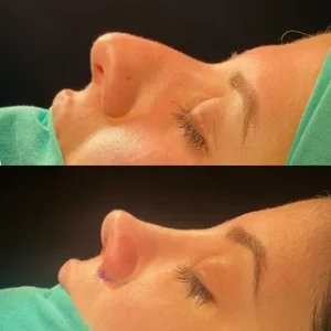 هزینه عمل بینی در شمال هزینه عمل بینی در شمال