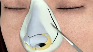 جراحی بینی با پیزوسرجری در آمل جراحی بینی با پیزوسرجری در آمل