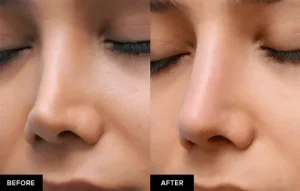 جراحی بینی با پیزوسرجری در آمل جراحی بینی با پیزوسرجری در آمل