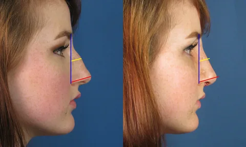 جراحی بینی با پیزوسرجری در آمل جراحی بینی با پیزوسرجری در آمل