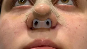 جراحی بینی با پیزوسرجری در آمل جراحی بینی با پیزوسرجری در آمل