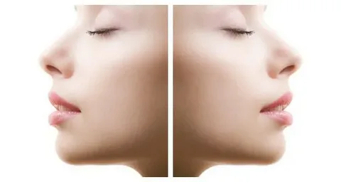 رفع مشکلات تنفسی همراه با جراحی بینی در آمل